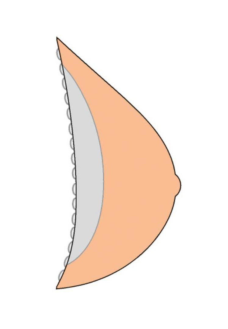 Side profile of the Amoena 386C Contact 3E breast form in ivory demonstrating full projection and natural breast curve